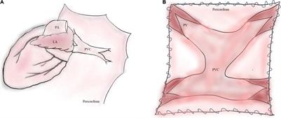 Sutureless Technique for Primary Total Anomalous Pulmonary Venous Connection Repair: An Updated Meta-Analysis